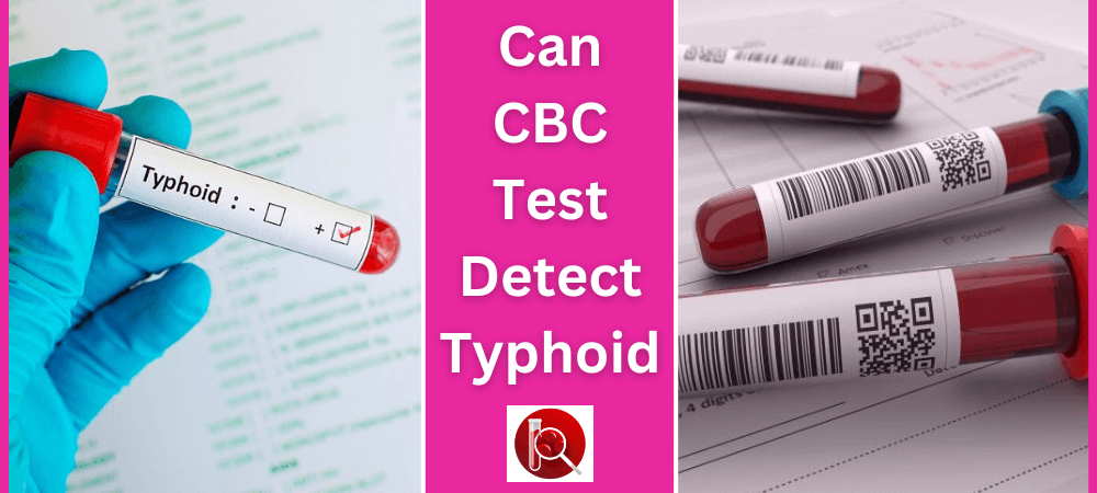 Can CBC test detect typhoid