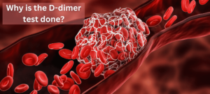 Why is the D-dimer test done?