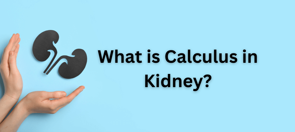 What is Calculus in Kidney?